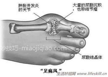 改善痛风的方法 