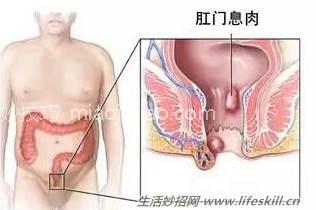 莫把息肉当痔疮！ 